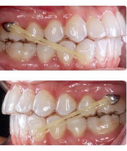 نمای بالینی از استفاده همزمان پلاک شفاف ارتودنسی (کلیر الاینر) با کش بینفکی برای اصلاح بایت و جابهجایی دقیق دندانها | Clinical view of clear aligner combined with interarch elastic bands for bite correction and controlled tooth movement