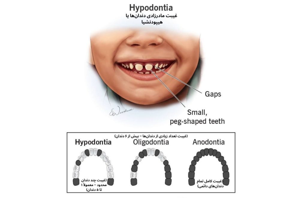 تصویر آموزشی از کودک مبتلا به غیبت مادرزادی دندانها (هیپودنشیا) که در آن فضاهای خالی بین دندانها و دندانهای کوچک و مخروطیشکل دیده میشود. در پایین تصویر، تفاوت میان سه نوع غیبت دندانی — هیپودنشیا، الیگودنشیا و آدنتیا — با نمودارهای شماتیک نشان داده شده است.
