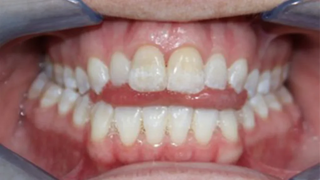 فشار زبان در بزرگسالان و تأثیر آن بر درمان ارتودنسی؛ نمونهای از تغییر موقعیت دندانهای قدامی بهدلیل عادت فشار زبان.