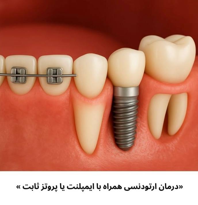 نمای دقیق از درمان ارتودنسی همزمان با ایمپلنت دندانی، نشاندهنده براکتهای ارتودنسی روی دندانهای طبیعی و ایمپلنت ثابت بدون براکت در بیماران دارای پروتز ثابت.