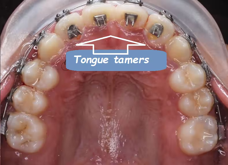 ابزار عادتشکن ارتودنسی در بزرگسالان برای کنترل فشار زبان و جلوگیری از بازگشت نتایج درمان ارتودنسی.