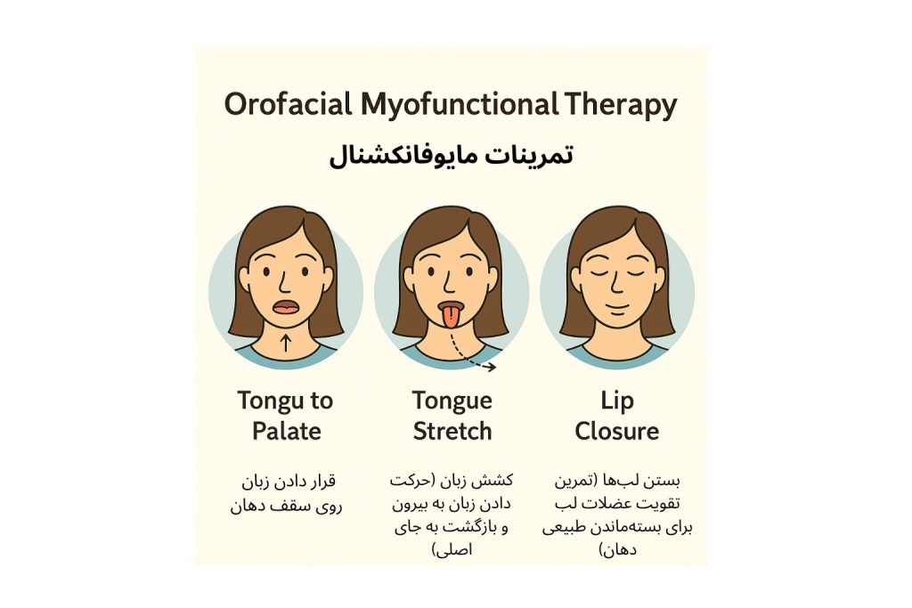 تمرینهای مایوفانکشنال برای بهبود عملکرد زبان و لبها در بزرگسالان و افزایش پایداری نتایج درمان ارتودنسی.