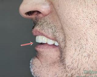 تفاوت ارتودنسی فک کوچک و فک بزرگ