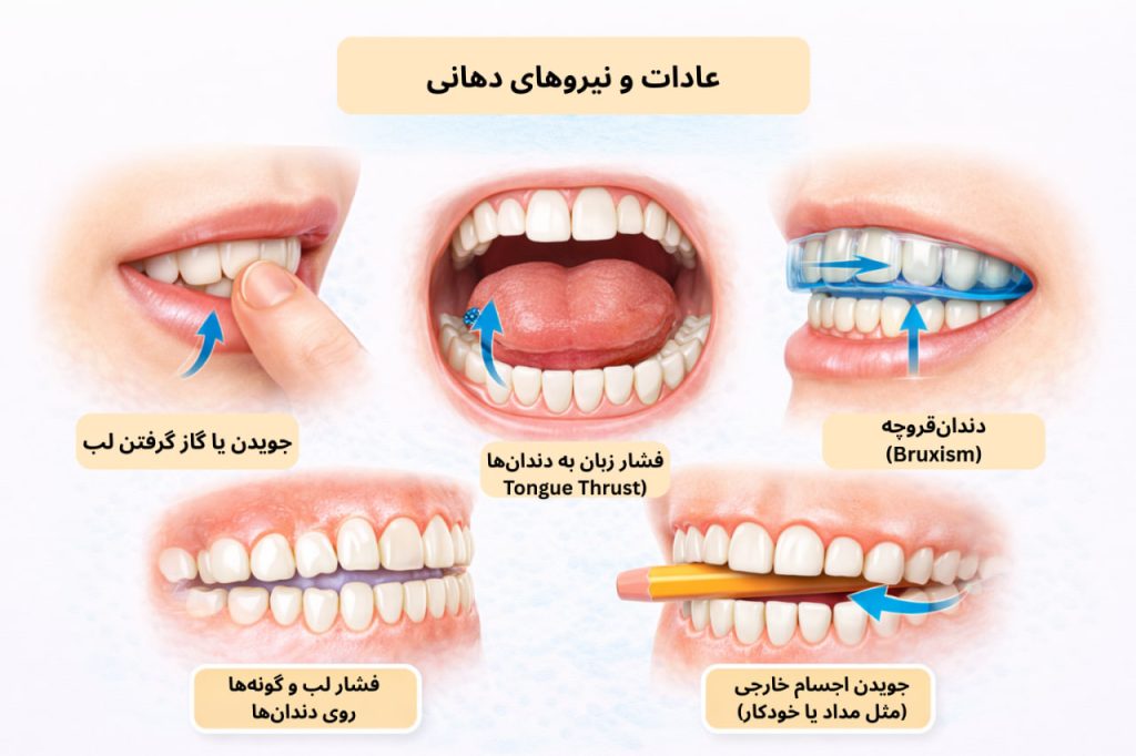 عادات و نیروهای دهانی مؤثر در حرکت دندان‌ها بعد از ارتودنسی مانند فشار زبان، دندان‌قروچه و جویدن لب