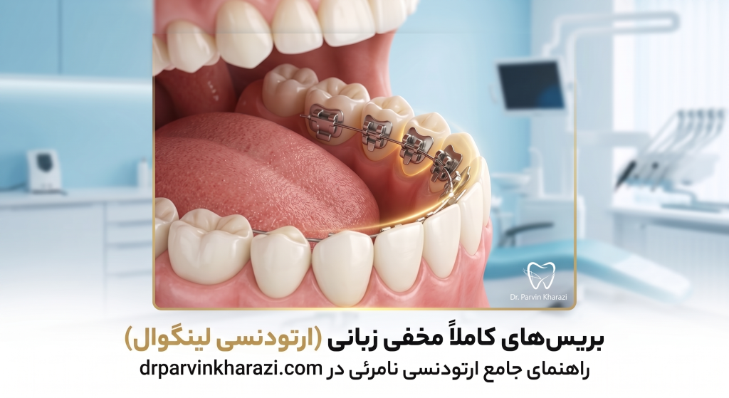 بریسهای زبانی (ارتودنسی لینگوال)