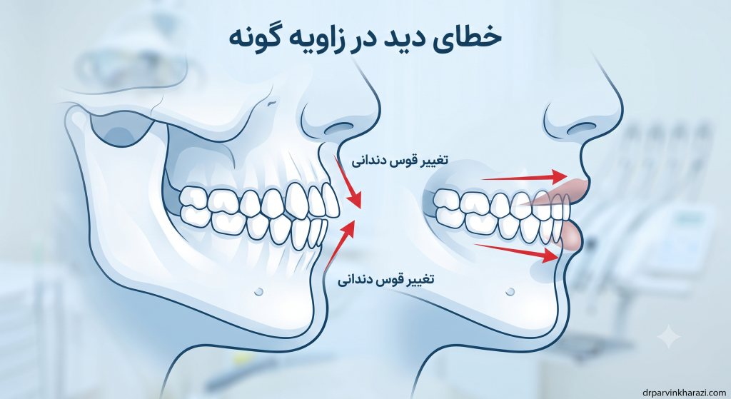 دیاگرام آموزشی بررسی خطای دید در برجستگی گونه پس از حرکت دندانها در ارتودنسی