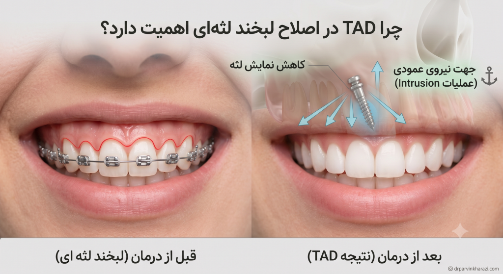 تاثیر مینیاسکرو ارتودنسی در اصلاح لبخند لثهای و کاهش نمایش اضافی لثه