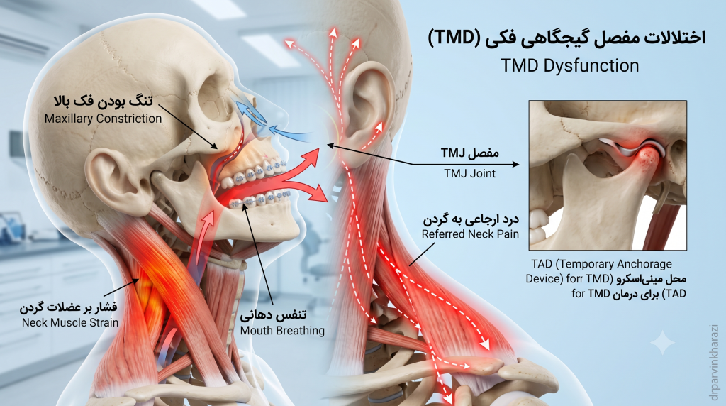 تصویر آناتومیک اختلالات مفصل گیجگاهی فکی TMD، التهاب و جابجایی دیسک مفصل و مسیر درد ارجاعی به گردن و شانه