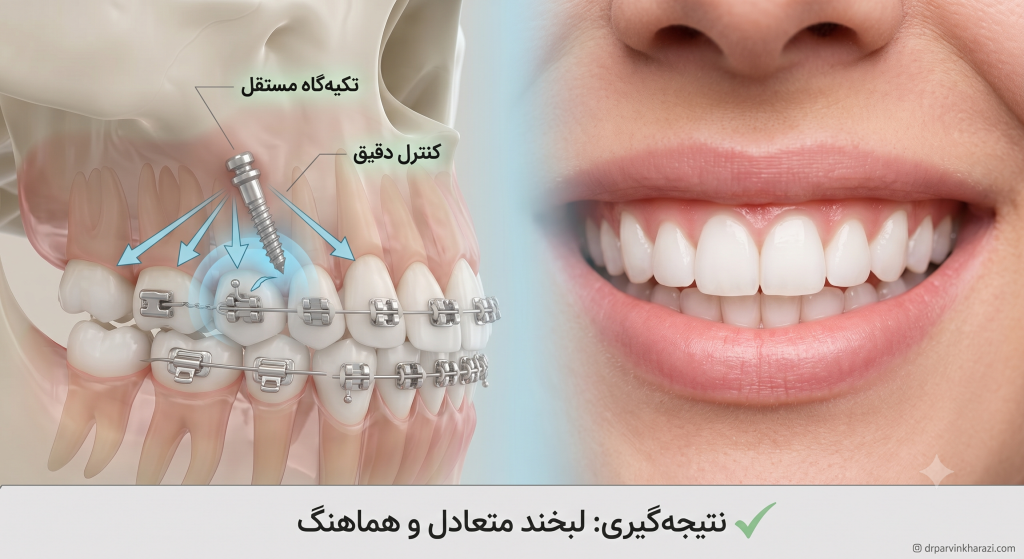 نتیجه نهایی درمان با مینیاسکرو ارتودنسی و دستیابی به لبخند متعادل
