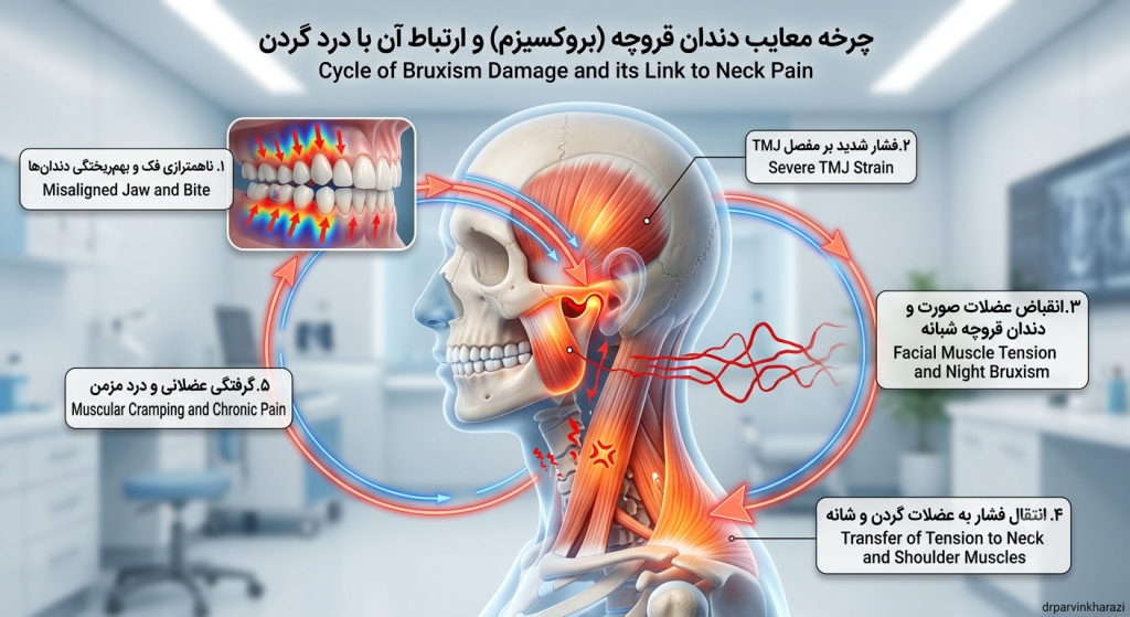 اینفوگرافیک چرخه معایب دندان قروچه بروکسیزم و نحوه انتقال فشار شدید شبانه از فک به عضلات گردن و شانه
