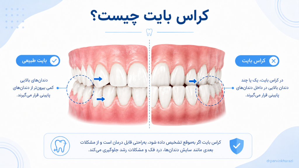 کراس بایت در ارتودنسی؛ مقایسه بایت طبیعی و قرارگیری نادرست دندانهای فک بالا و پایین