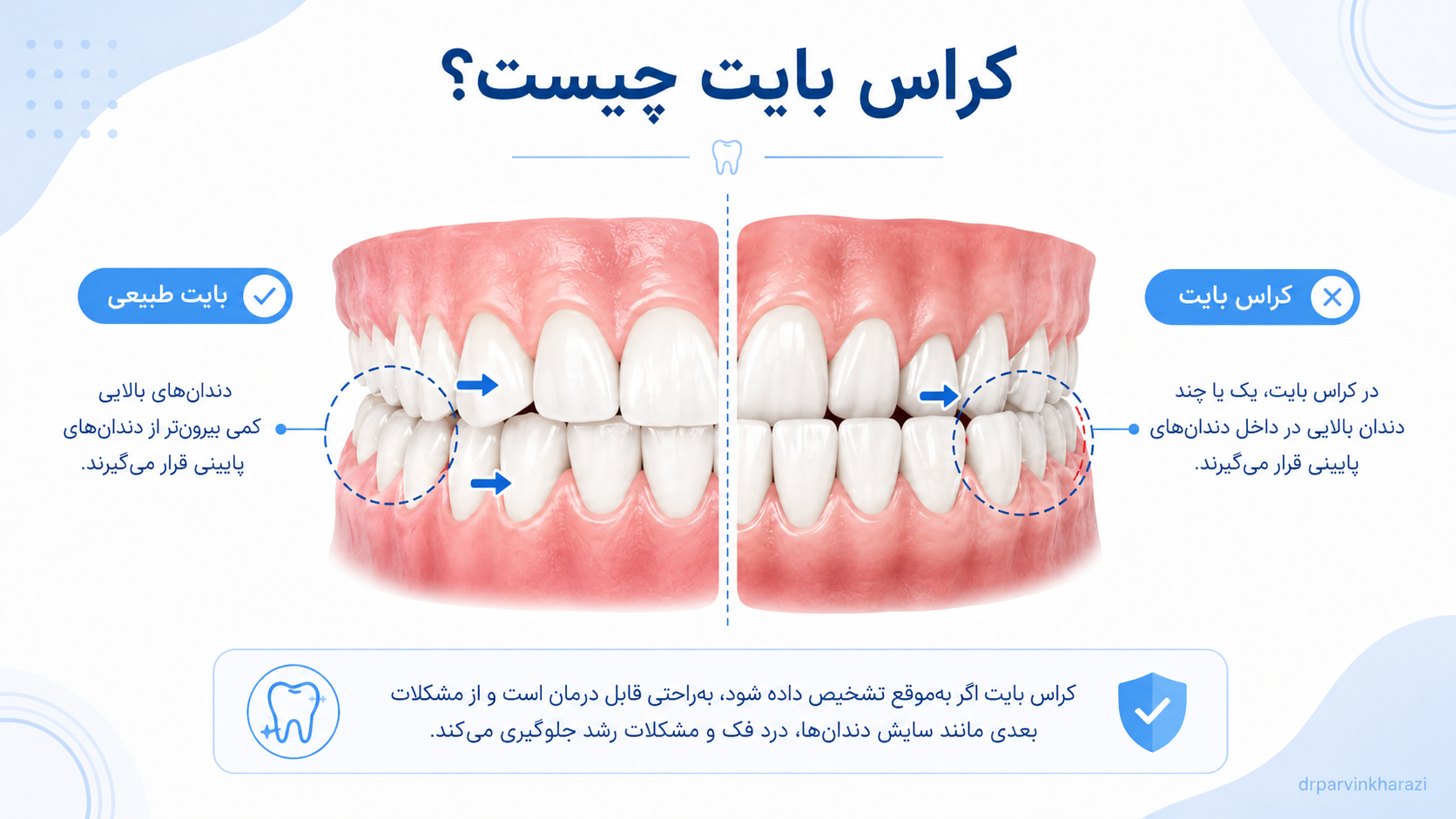 کراس بایت در ارتودنسی؛ مقایسه بایت طبیعی و قرارگیری نادرست دندانهای فک بالا و پایین