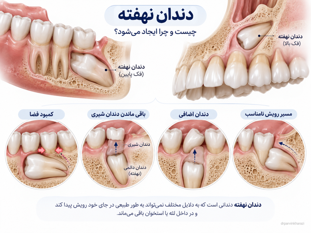 نمایش دندانهایی که به دلیل کمبود فضا مسیر رویش طبیعی ندارند