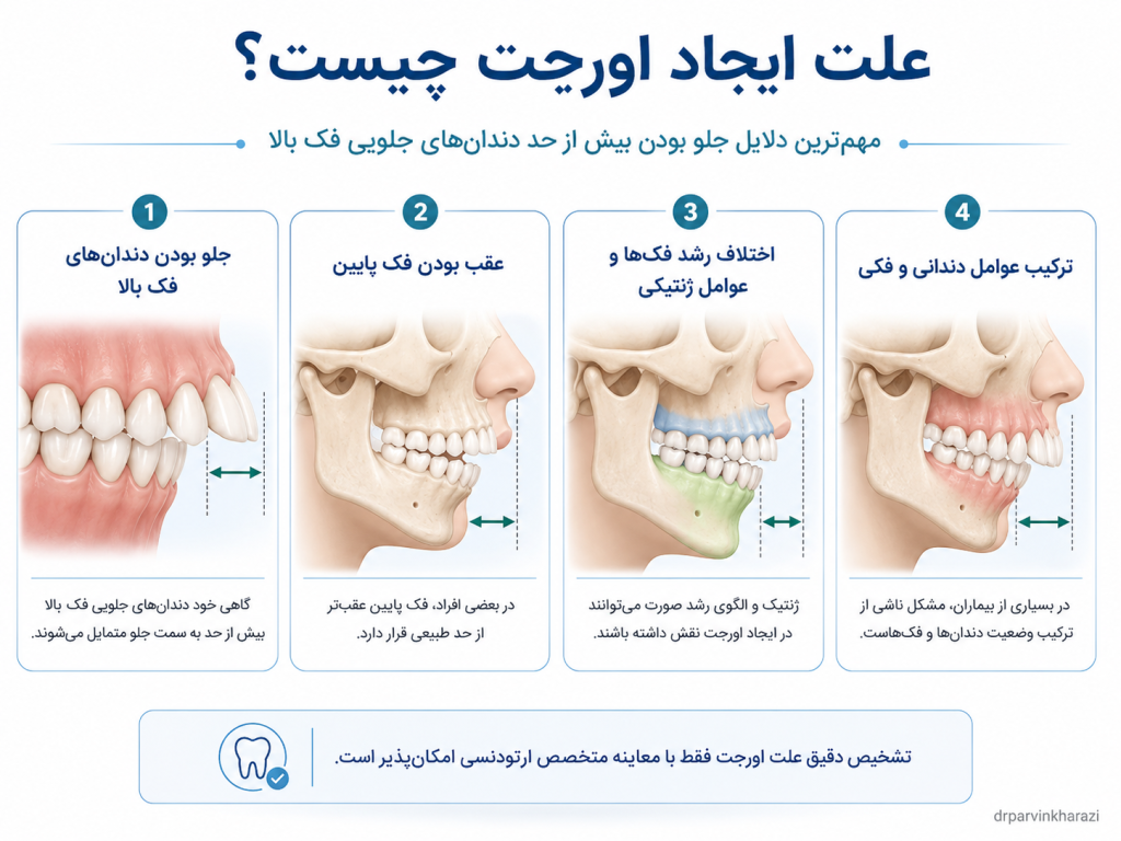 علت‌های ایجاد اورجت در ارتودنسی شامل جلو بودن دندان‌های فک بالا، عقب بودن فک پایین، عوامل ژنتیکی، عادات دهانی و ترکیب عوامل دندانی و فکی