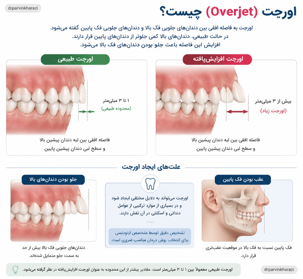 اورجت چگونه تشخیص داده می‌شود؟ اینفوگرافیک مراحل تشخیص اورجت در ارتودنسی شامل معاینه دندان‌ها، اندازه‌گیری فاصله افقی، بررسی فرم صورت و فک‌ها، نحوه بستن دهان، رادیوگرافی سفالومتری و بررسی سابقه رشد و عادت‌های دهانی