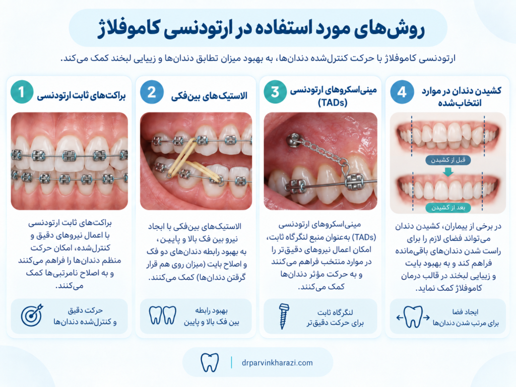 روش‌های مورد استفاده در ارتودنسی کاموفلاژ شامل براکت ثابت، الاستیک بین‌فکی، مینی‌اسکرو ارتودنسی و کشیدن دندان در موارد انتخاب‌شده