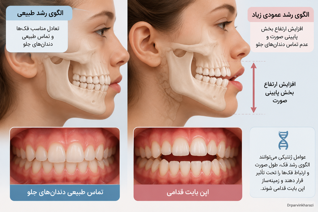 تأثیر عوامل ژنتیکی و الگوی رشد عمودی فک بر ایجاد اپن بایت قدامی و نرسیدن دندانهای جلو به یکدیگر