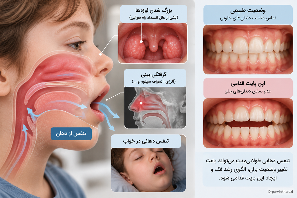 تأثیر تنفس دهانی و مشکلات راه هوایی مانند گرفتگی بینی و بزرگ شدن لوزهها بر ایجاد اپن بایت قدامی
