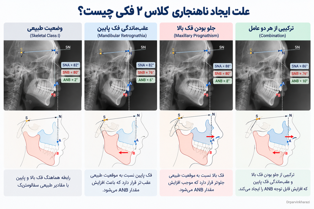 علت ایجاد ناهنجاری کلاس ۲ فکی؛ عقب بودن فک پایین یا جلو بودن فک بالا